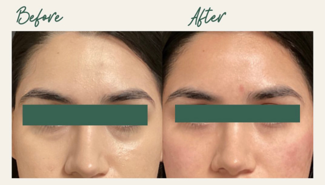 Under Eye Filler